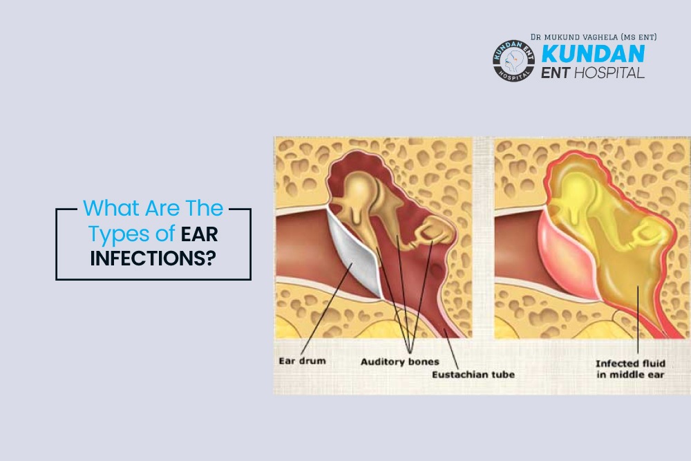 Types Of Ear Infections